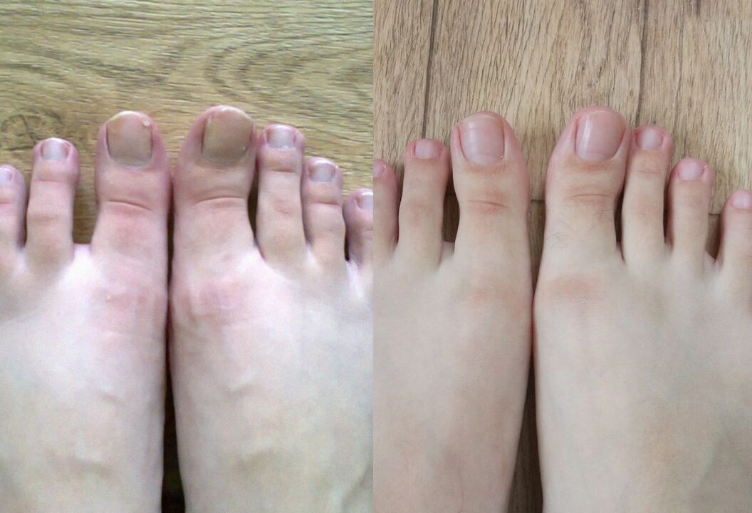 Pirms un pēc ārstēšanas sēnītes soles krēms