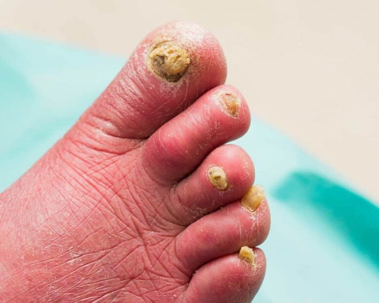 Onychomycosis simptomi