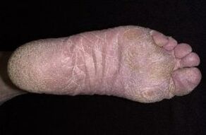 Sēnes pazīmes un simptomi uz kājām