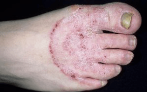 Sēnītes parādīšanās iemesli uz kājām