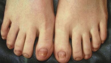 Nagu sēnītes attīstības posmi