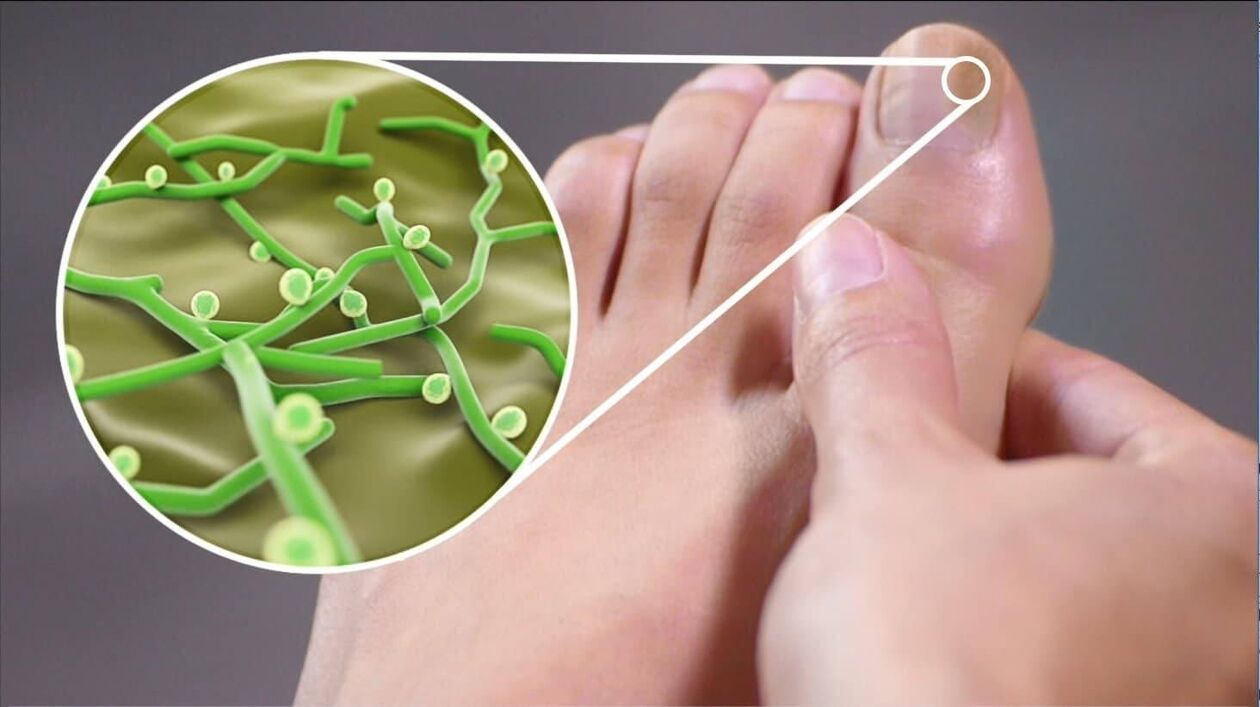 kāju nagu sēnīšu patogēni