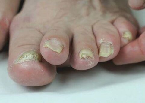 nagu sēnīšu ārstēšana ar medikamentiem