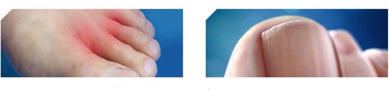 pēdu sēnītes sākuma stadija